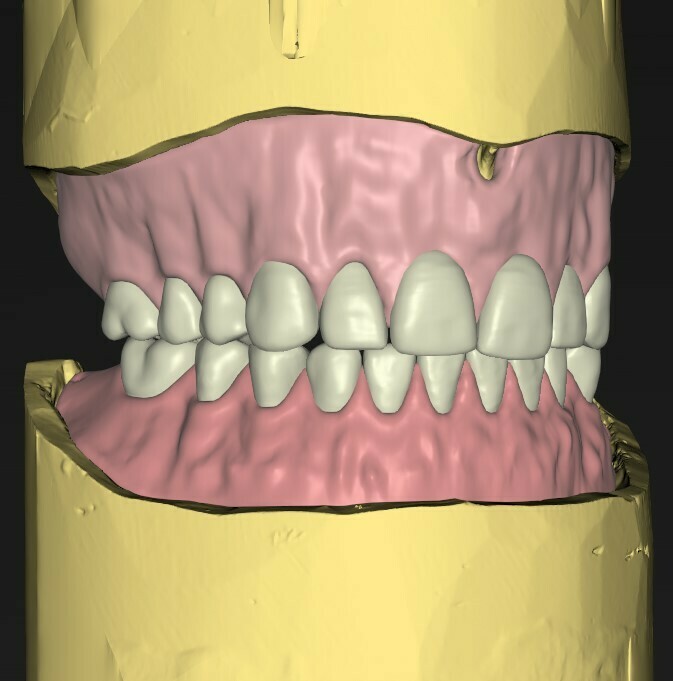 The exocad DentalCAD interface displaying a 3D-rendered lower jaw with implants and digitally designed teeth. 