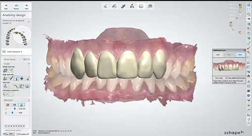 A computer-aided design interface showing 3D-modeled crowns placed over a digital impression of a patient's lower teeth.  